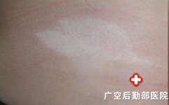白癜风患者为什么不能吸烟 白癜风患者为什么不能吸烟