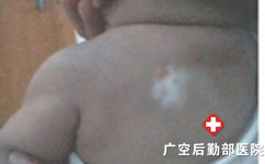 白癜风三大症状表现 白癜风三大症状表现