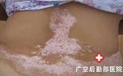 诊断白癜风的方法有哪些 诊断白癜风的方法有哪些