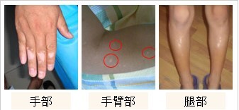 手部出现白斑是不是白癜风