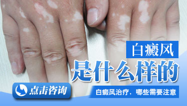 白癜风的特征都有哪些 白癜风的特征都有哪些